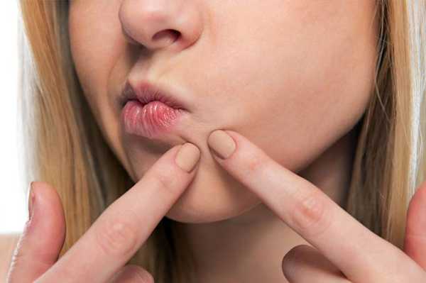 मुंहासे का 13 घरेलु उपचार - 13 Homemade Remedies for Acne