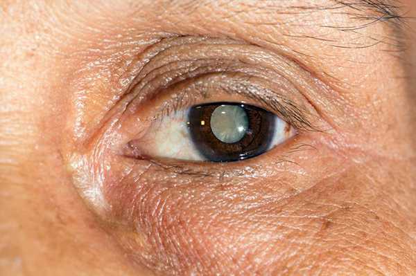 मोतियाबिन्द का 8 घरेलु उपचार - 8 Homemade Remedies for Cataract