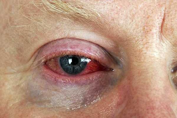 आंख लाल पड़ने का 6 घरेलु उपचार - 6 Homemade Remedies for Eye Redness