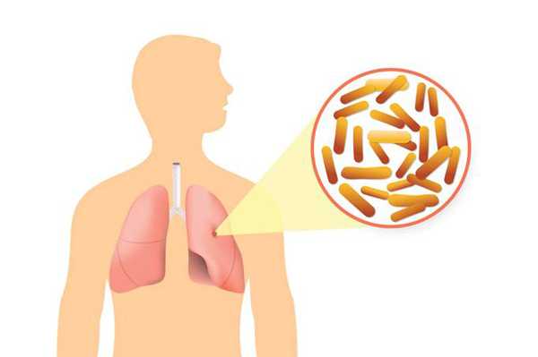 तपेदिक (टी.बी.) का 23 घरेलु उपचार - 23 Homemade Remedies for Tuberculosis (TB)