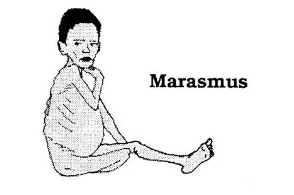 सूखा रोग का 7 घरेलु उपचार - 7 Homemade Remedies for Marasmus