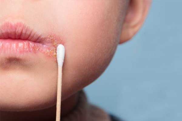 मुंह के छाले का 14 घरेलु उपचार - 14 Homemade Remedies for Cold Sores